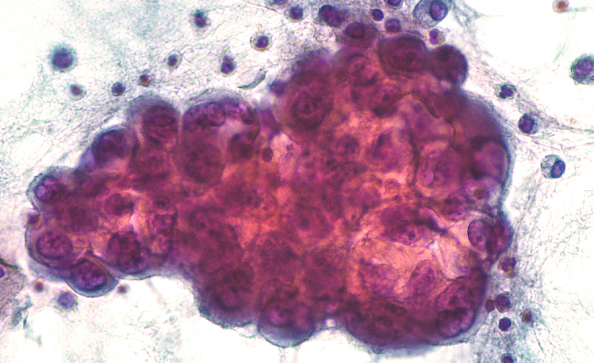 Luncancer_548003581